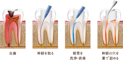 歯内を洗浄し歯を残す