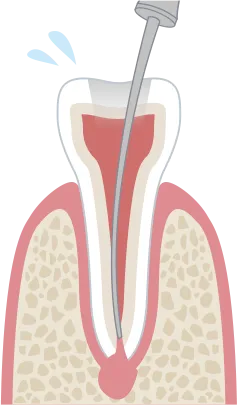 ラバーダム防湿を行わない場合