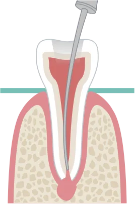 ラバーダム防湿を行った場合