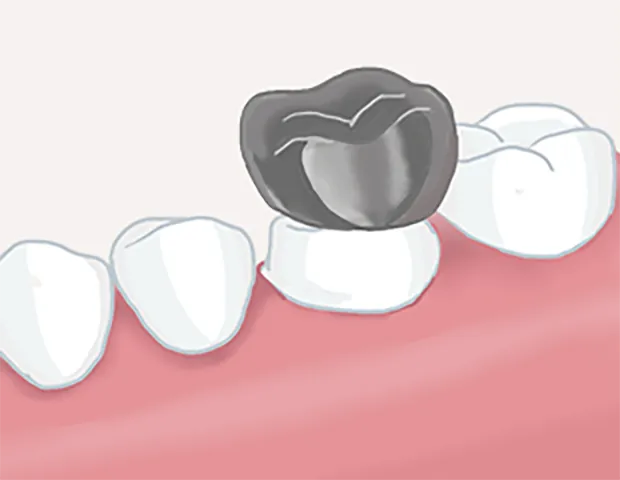 被せ物の装着