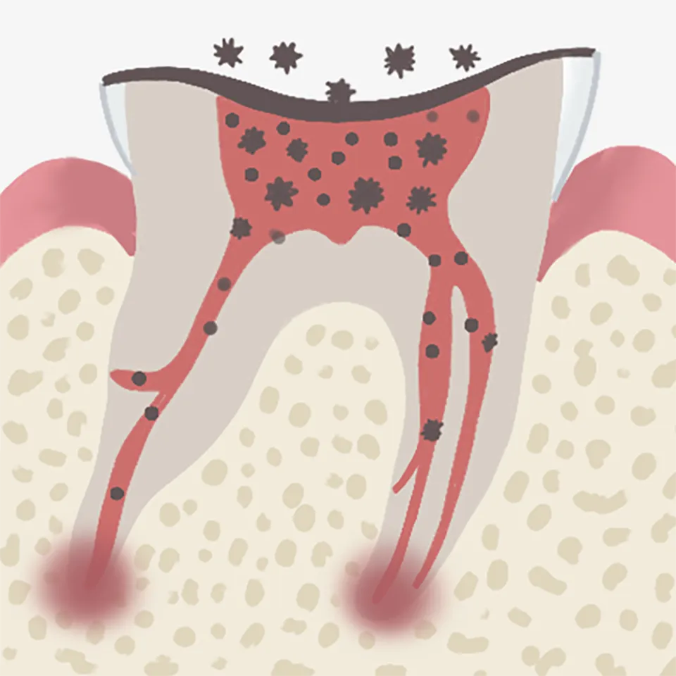 歯の根の病巣を切除する