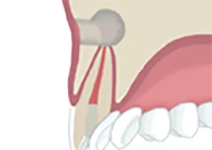 歯根の切断