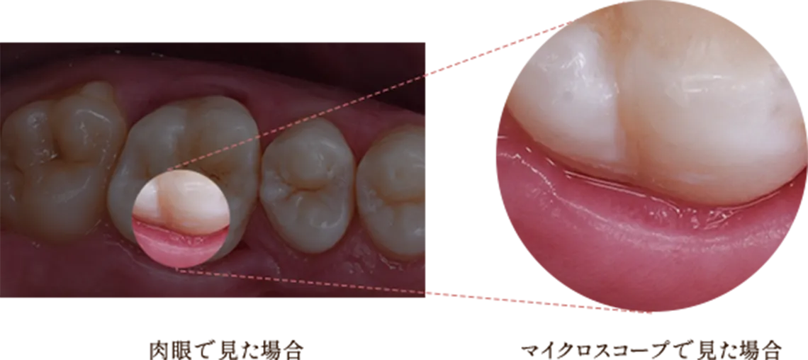  マイクロスコープ下の精密治療