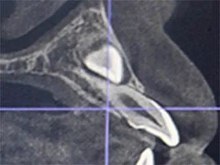 歯のレントゲン画像