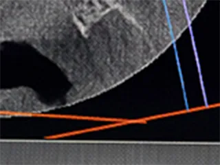 歯のレントゲン画像