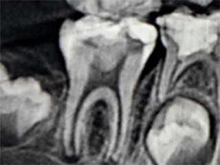 歯のレントゲン画像