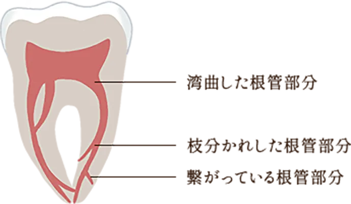  マイクロスコープ下の精密治療