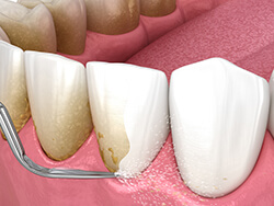 スケーリング歯石除去