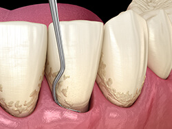ルートプレーニング歯根面の研磨