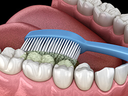 歯磨き指導デンタルフロス
