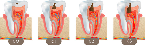 むし歯の進行ステージ