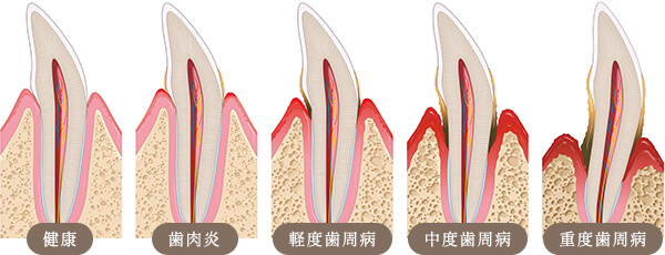 歯周病の進行ステージ
