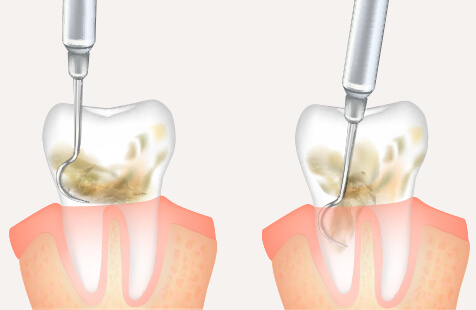 治療プログラム