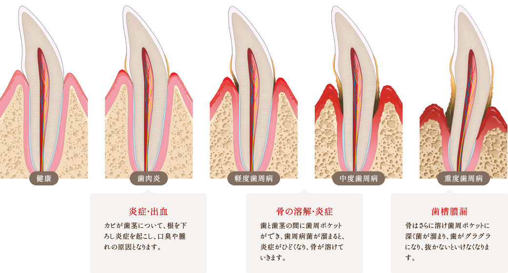 歯周病の進行度