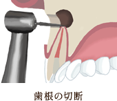 歯根の切断