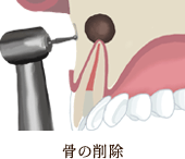 骨の削除