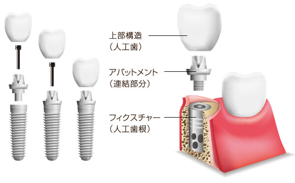 インプラント構造
