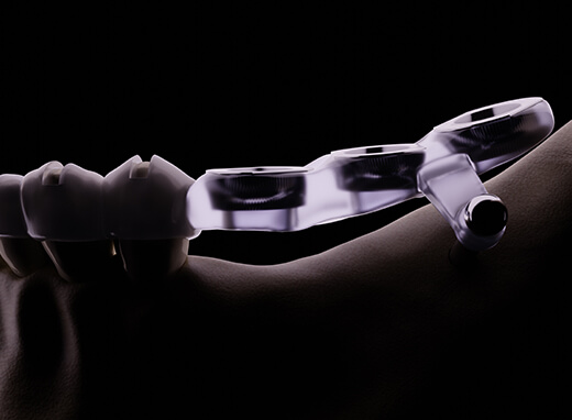 ガイデッドサージュリーシステム