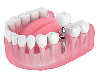 歯を1本失った場合