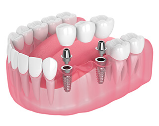 歯を複数失った場合