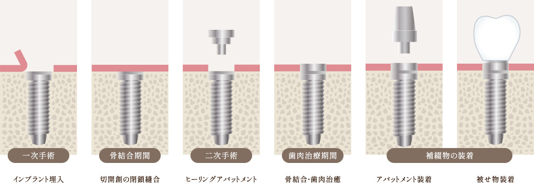 インプラント埋入