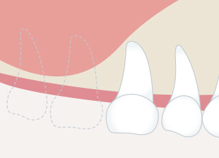 サイナスリフト