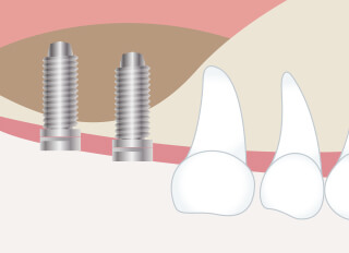 サイナスリフト