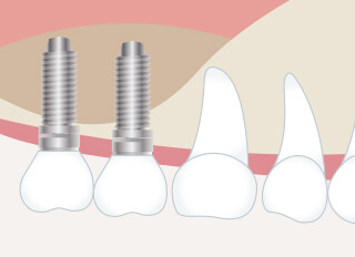 サイナスリフト