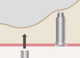 ソケットリフト