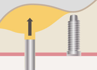 ソケットリフト