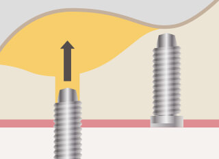 ソケットリフト