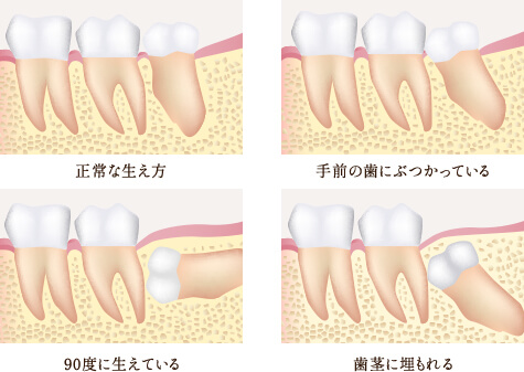 親知らずの抜歯