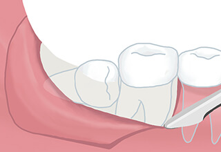 歯茎の切開する