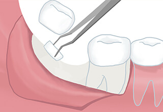 親知らずを取り除く