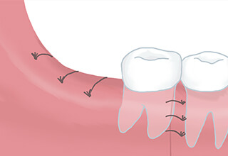 歯茎を縫合する