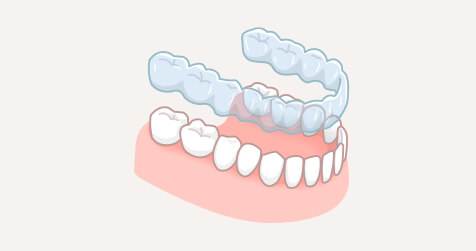 透明マウスピース矯正