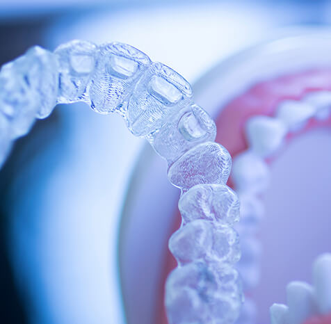 ライフスタイルに沿った矯正装置