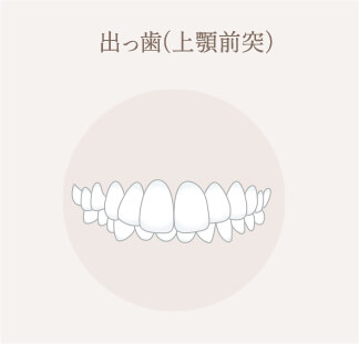 出っ歯（上顎前突）