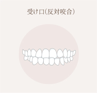 受け口（反対咬合）