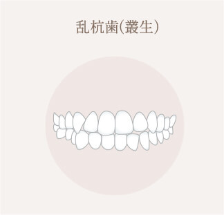 乱杭歯（叢生）