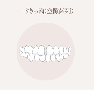 すきっ歯（空隙歯列）