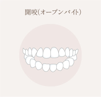 開咬（オープンバイト）