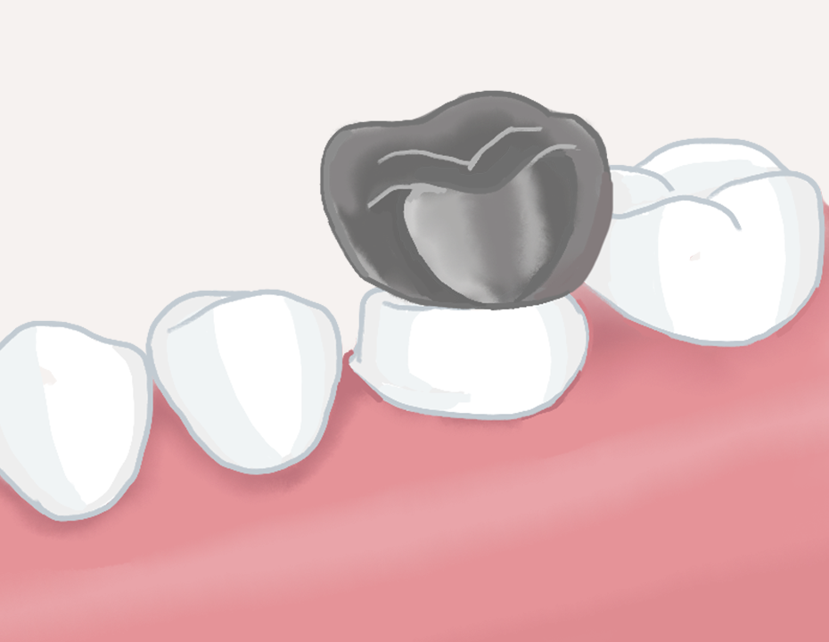 被せ物の装着