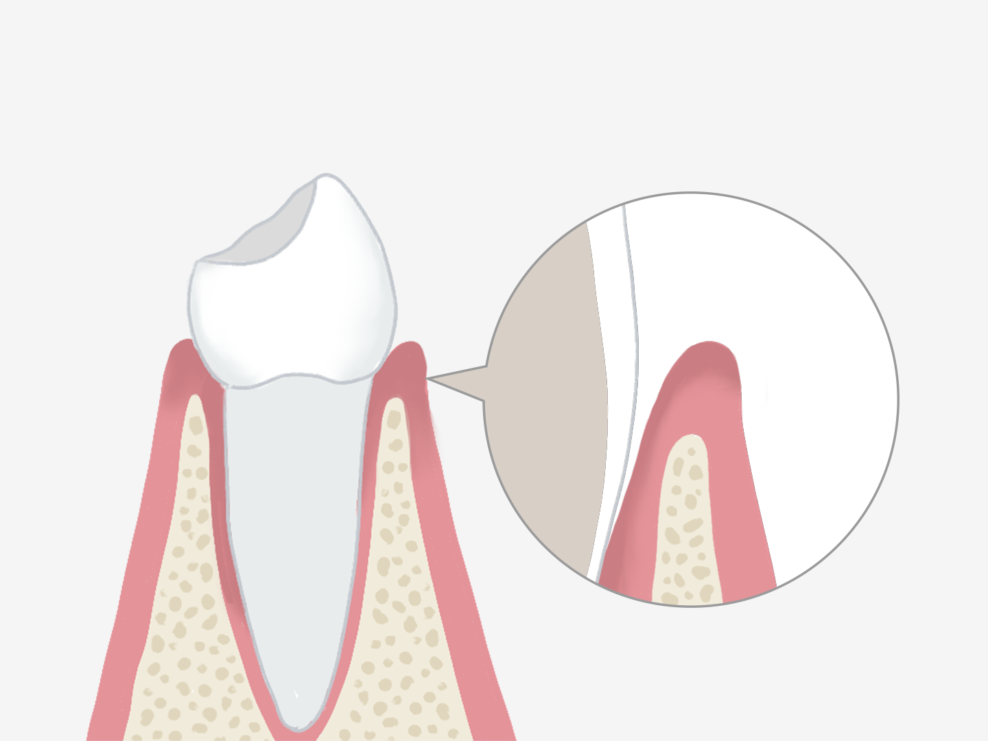 歯周組織再生治療イメージ